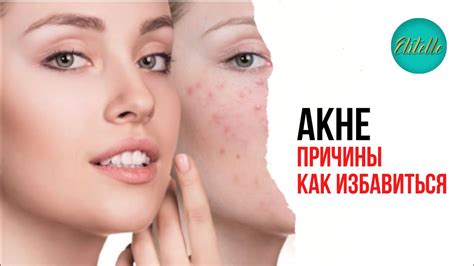 Акне и причины его возникновения