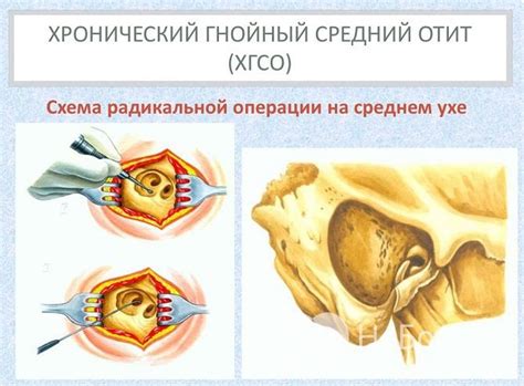 Альтернативные подходы к лечению гнойного отита