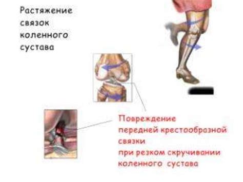 Альтернативы гипсу при повреждении связок колена