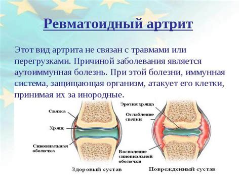 Артрит и ревматоидный артрит