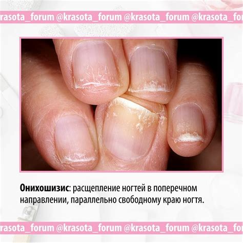 Болезни ногтевых пластин