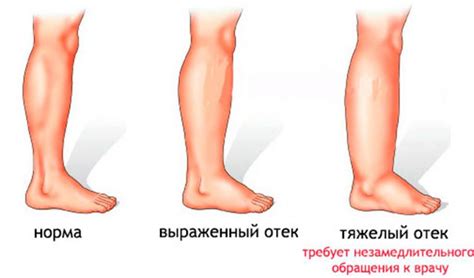 Венозная недостаточность и отеки ног: симптомы и лечение