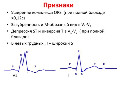 Взаимосвязь между инфарктом миокарда и нарушением проводимости пучка Гиса