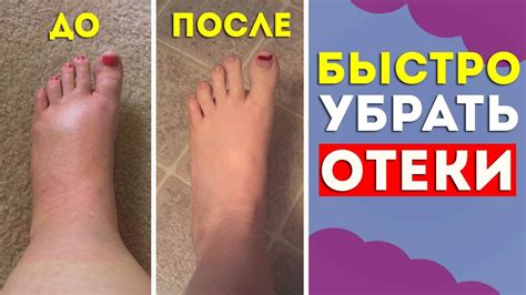 Влияние гормонов на отеки ног