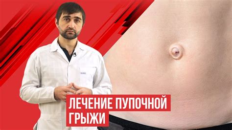 Влияние йоги на пупочную грыжу