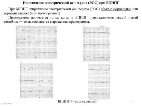 Влияние нарушения внутрижелудочковой проходимости на организм