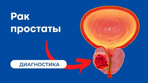 Влияние рака предстательной железы на работоспособность