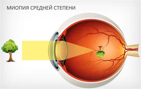 Влияние факторов на результаты лечения высокой степени близорукости у взрослых