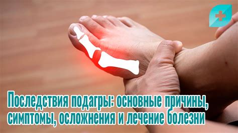 Вода и осложнения подагры