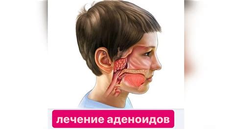 Воздействие расширения и воспаления аденоидов на функционирование дыхательной системы