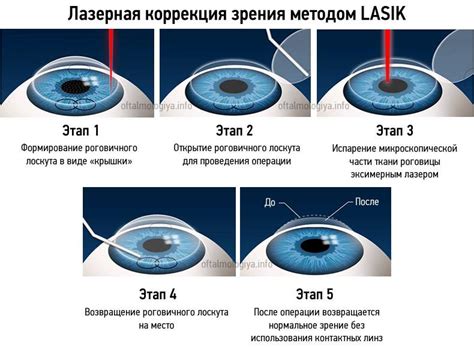 Возможные осложнения после коррекции зрения при помощи лазерной процедуры и пути их предотвращения