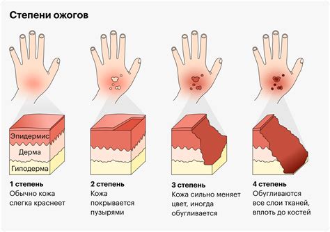 Волдырь после ожога: первая помощь