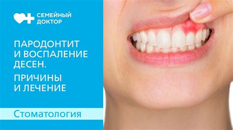 Воспаление десен и возможные последствия