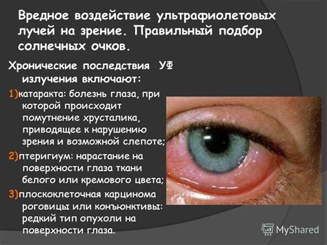 Вредное воздействие ультрафиолетовых лучей на образования эпителиальной природы