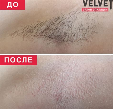 Выбор кожи для восковой депиляции: подготовка и очищение