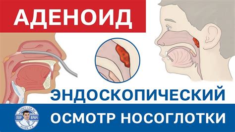 Гипертрофия глоточной миндалины у ребенка