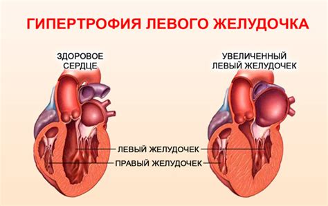 Гипертрофия левого желудочка: диагностика и причины