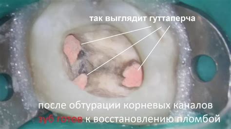 Горячая гуттаперча в стоматологии: применение