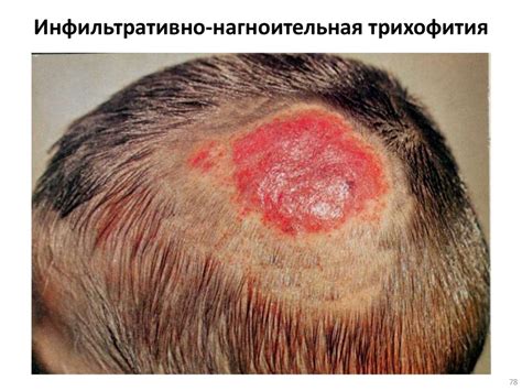 Грибковые заболевания стопы