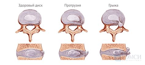 Грыжа межпозвоночного диска