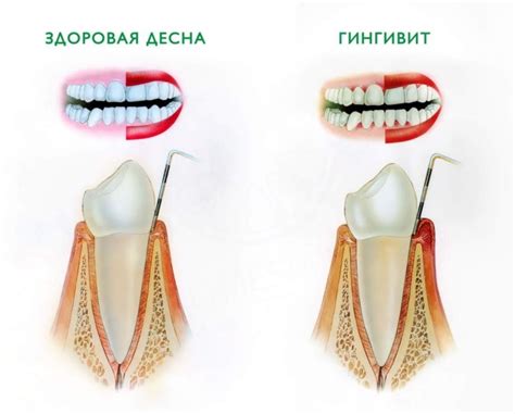 Деструкция зубов и десен