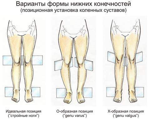 Деформация суставов