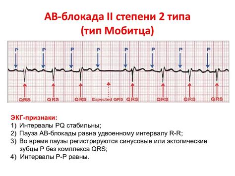 Диагностика блокады 2 типа