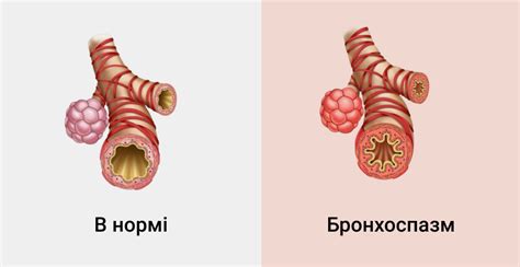 Диагностика бронхоспазма