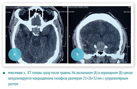 Диагностика и лечение высокого уровня щитовидно-регулирующего гормона у маленького пациента