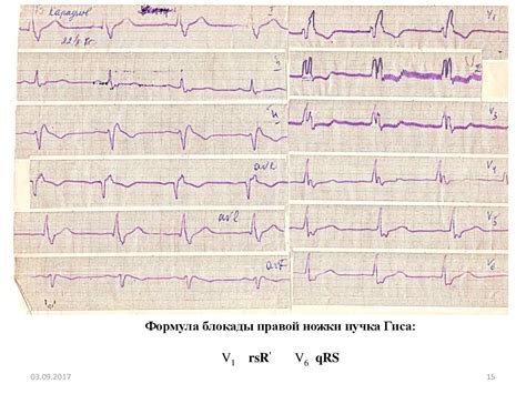 Диагностика нарушения внутрижелудочковой проходимости