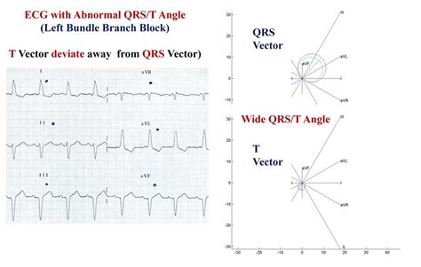 Диагностика нарушения формы QRS-T