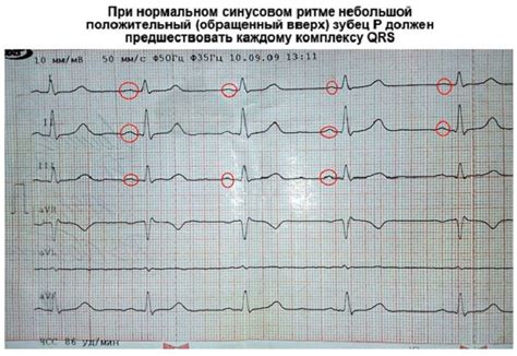 Диагностика сердечных проблем: как помогает ЭКГ