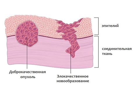 Доброкачественная опухоль