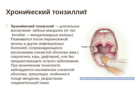 Домашние методы лечения гнойников на миндалинах