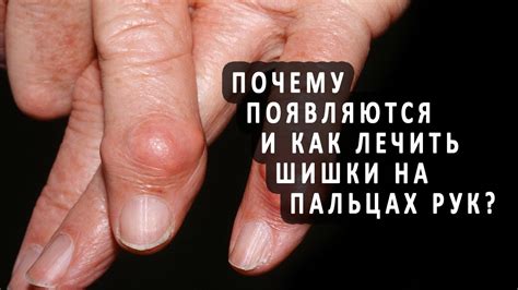 Домашние методы лечения шишки на руке