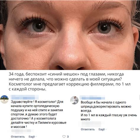 Домашние методы устранения мешков под глазами