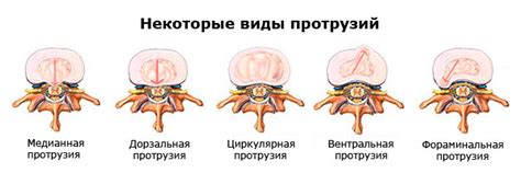 Дорзальные протрузии дисков L3-5: общая информация