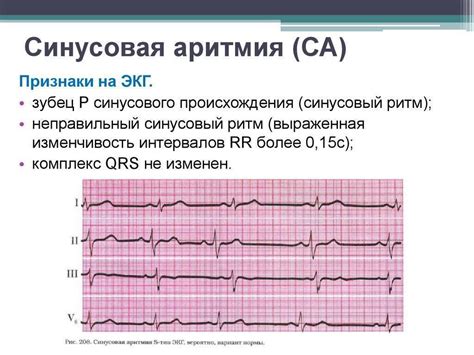 Дыхательная аритмия у детей