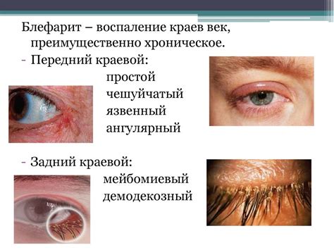 Заболевания век и воспалительные процессы