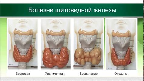 Заболевания щитовидной железы и их влияние на сердце