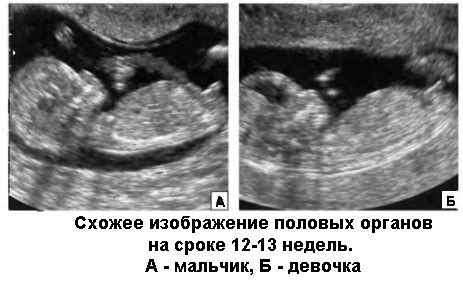 Зависимость пола плода от его расположения