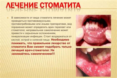 Заразность стоматита