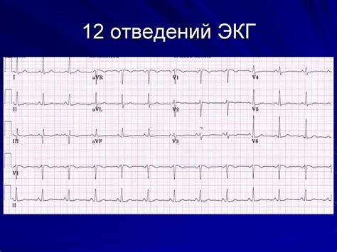 Значение ЭКГ в поликлинике: важность и преимущества