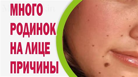 Значение родинок для здоровья