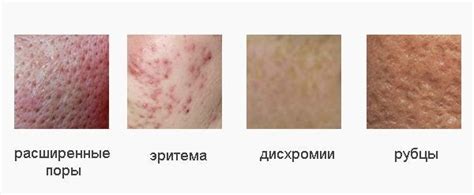 Инъекционные методы борьбы с шрамами