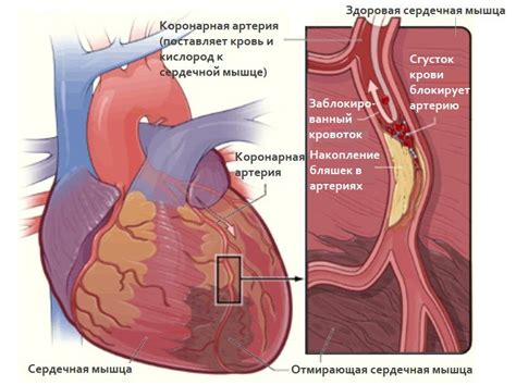 Ишемическая болезнь сердца