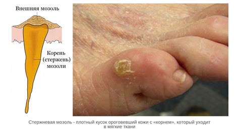 Как быстро избавиться от гнойника на пальце