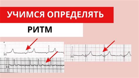 Как диагностировать предсердный ритм с помощью ЭКГ