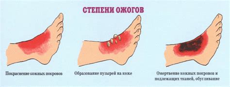 Как определить ожог