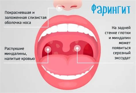 Как определить шишечки в горле